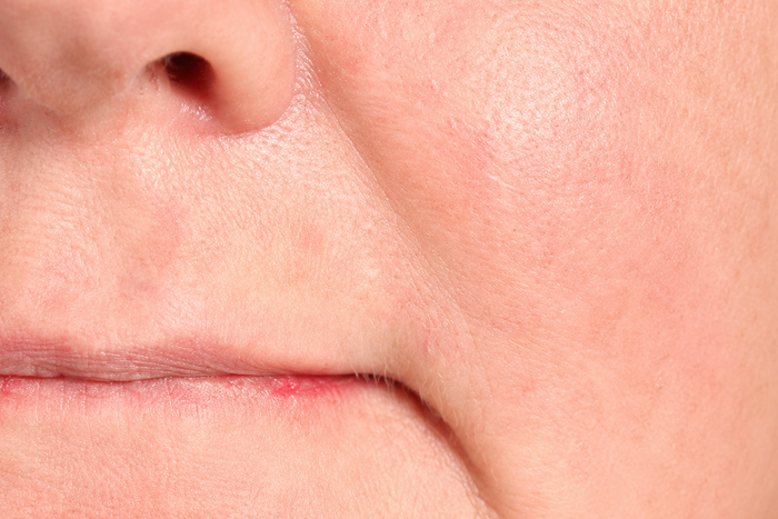 Nasolabial Folds: What Causes Them and How to Soften the Look